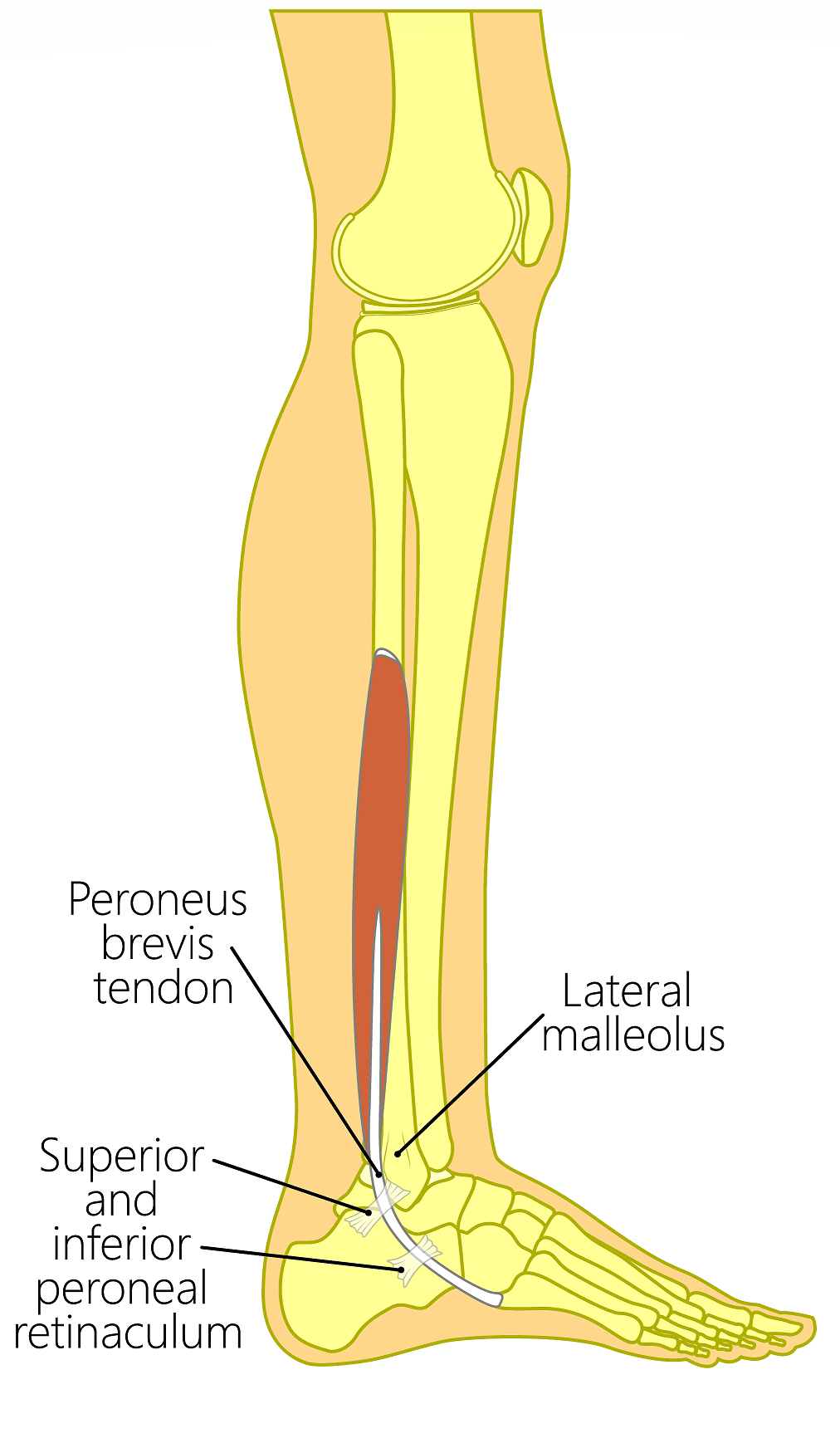 Peroneus Brevis Tears Tendonitis Fix Peroneus Brevis Tendon Pain