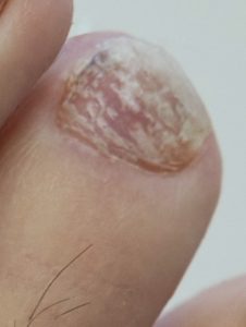 What Are Horizontal Lines On Toenails Dark White Red Or Black Lines