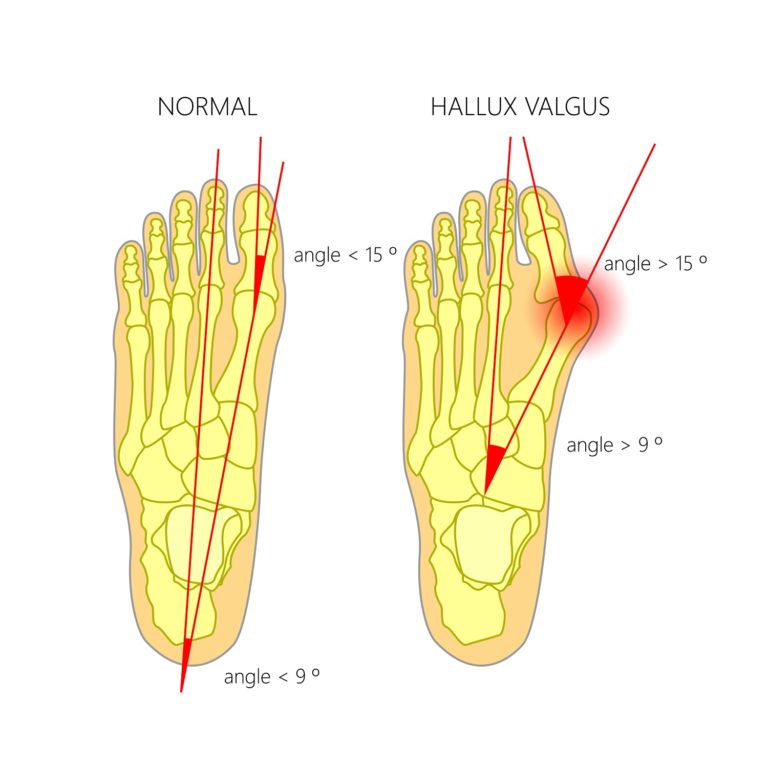 Dislocated Big Toe Pinky Toe Causes Symptoms Best Treatment