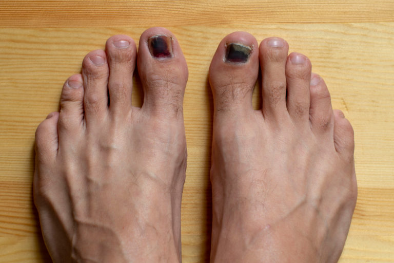 Toe Nail Coming Off The Nail Bed Causes Remedies Best Treatment 