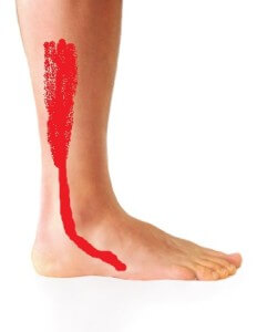Peroneus Longus Tendonitis Peroneus Longus Tendonitis