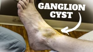 Aspiration of a Ganglion Cyst Procedure and Recovery Time: Does It Hurt?