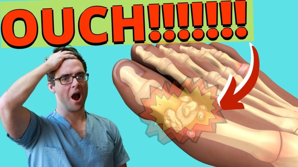 Foot Gout Pain [Big Toe & Ball of the Foot Causes & Best Treatment]