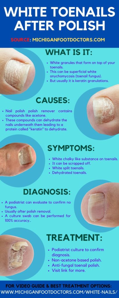 White Spots On Toenails Causes Home Remedies Best Treatment 