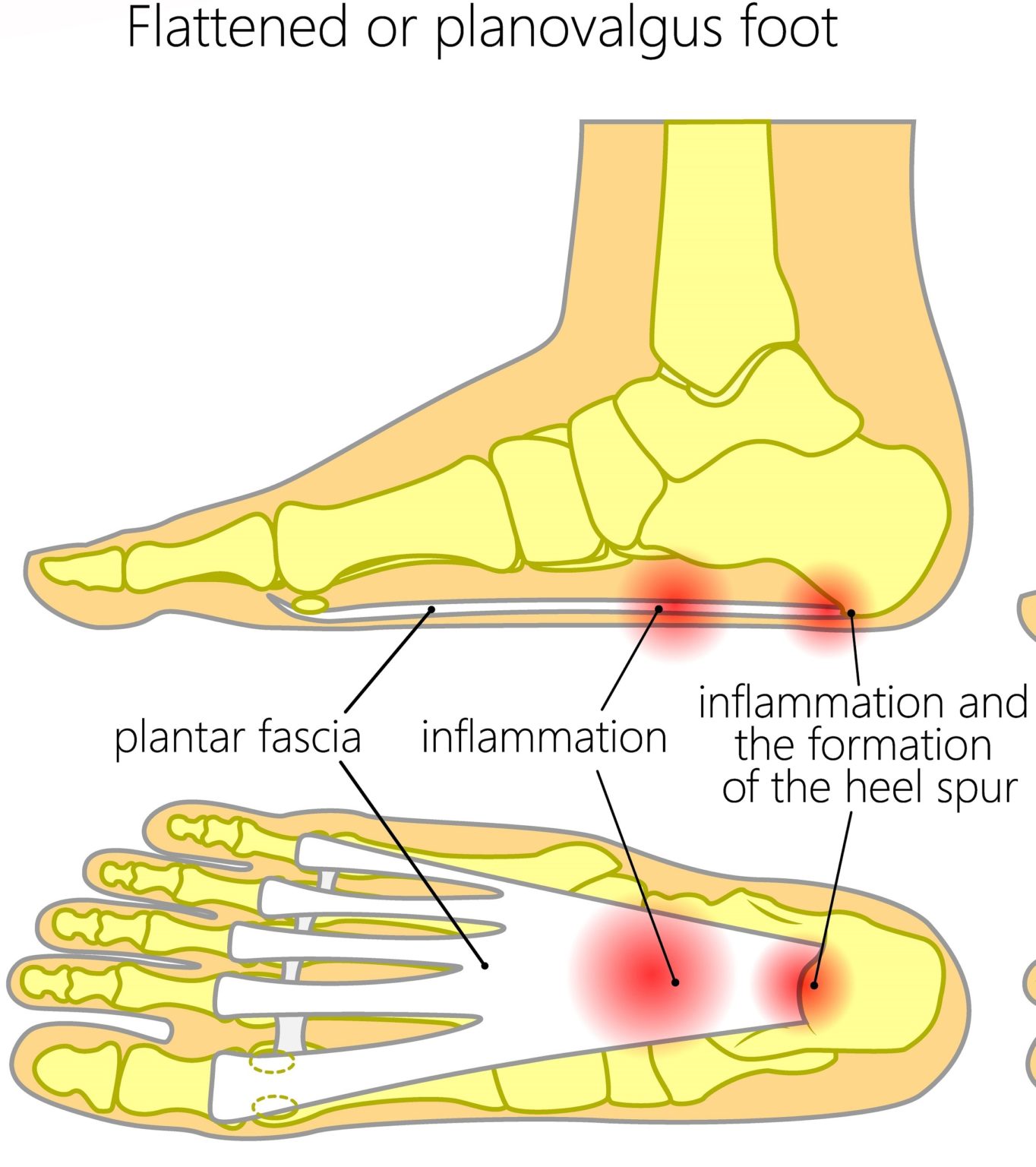 Plantar Fascia Strain [Causes, Symptoms & Best Home Treatment]