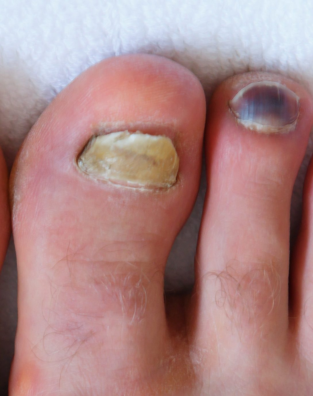 Green Under Fingernail Or Toenail SECRETS Shared By A Foot Doctor 