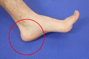 Painful Swelling on the Sole of the Foot: [Causes & Best Treatment]