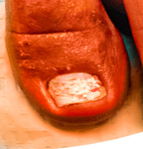 White Chalky Toenails From Toenail Polish.