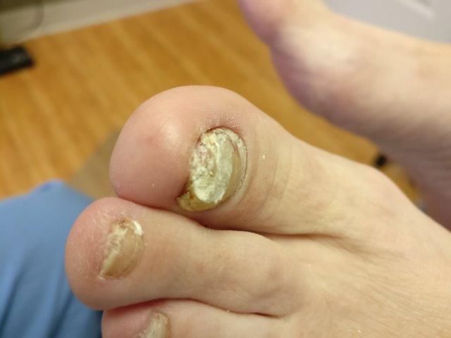 Keratin Granulations or Toe Nail Fungus?[ Causes & Best Treatment]