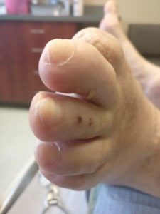 thick white toenails with white marks and white spots