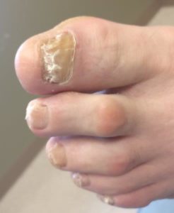 white stains, white spots and white streaks on the toenails