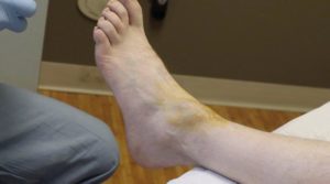 ganglion cyst drainage