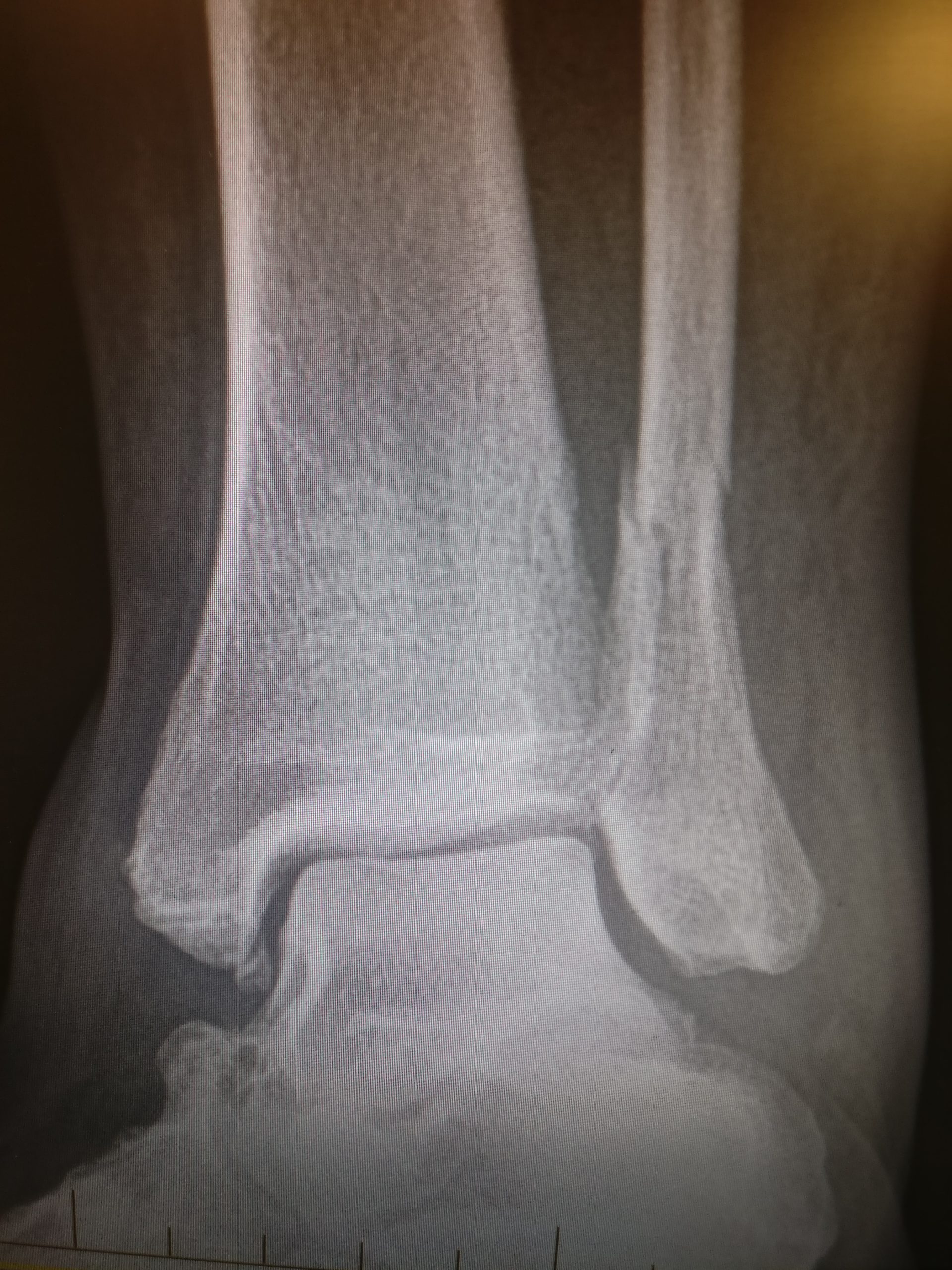 Chipped Shin Bone: Make 100% sure it's not broken!