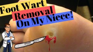 wart treatment 3