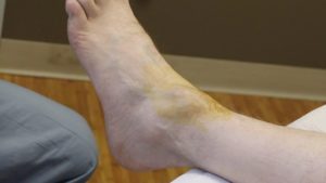 ganglion cyst drainage