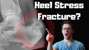 heel stress fracture