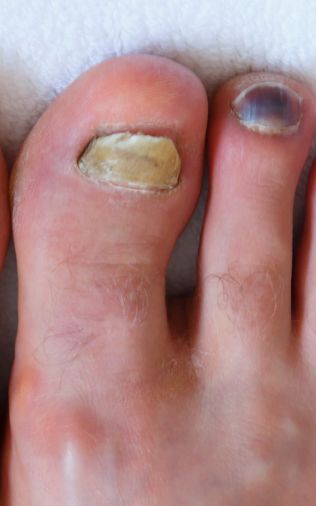 Toe Nail Coming Off The Nail Bed Causes Remedies Best Treatment 