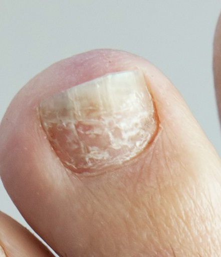 Why Do I Have Horizontal Ridges On My Toenail A Dent In My Toenail 