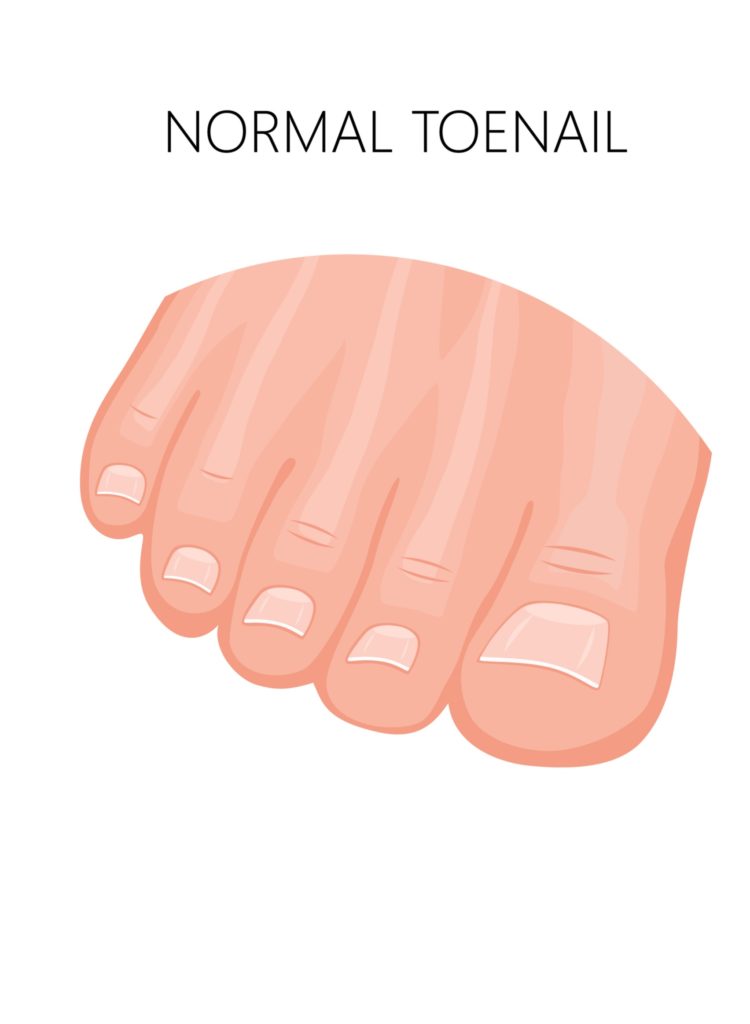 Ingrown toenails normal toenail - Balance Foot & Ankle Specialists