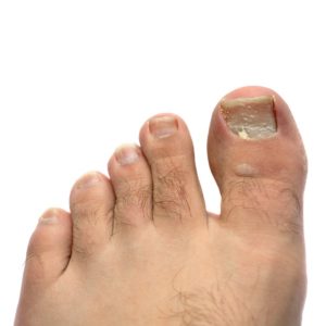 White Toenail Fungus vs. keratin granulations 3 12