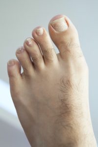 White Toenail Fungus vs. keratin granulations 5