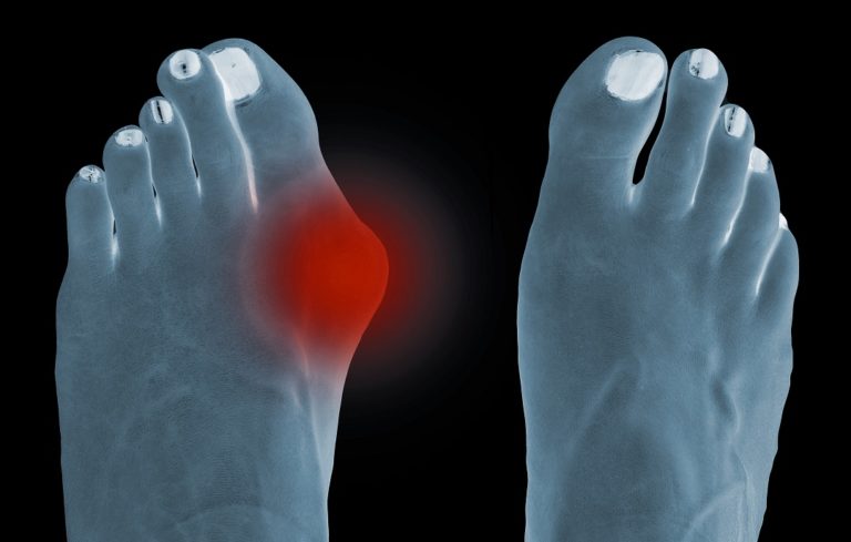 Bone Spurs Big Toe: AKA Stiff Big Toe or Hallux Rigidus [Best Treatment]