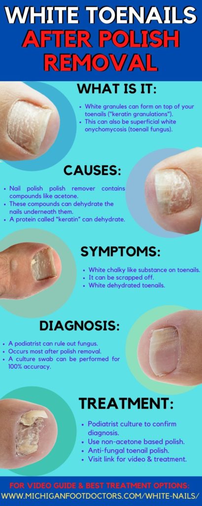 White Chalky Toenails From Nail Polish The Complete Treatment Guide 