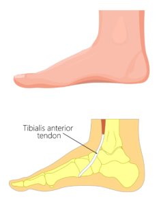 Anterior tibialis