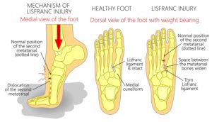 Pain in Middle of the Foot [Causes, Symptoms and Best Treatment]