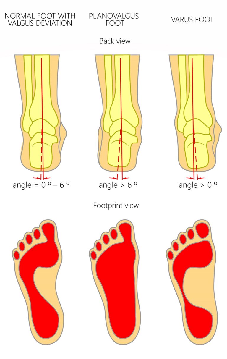 Heel Pain Podiatrist Treatment [Plantar Fasciitis & Heel Spur Foot Doctors]