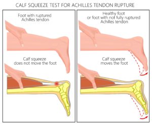 Thompsons squeeze test