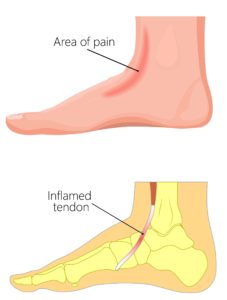 Extensor Tendonitis in Foot [Top of the Foot Tendonitis Treatment]