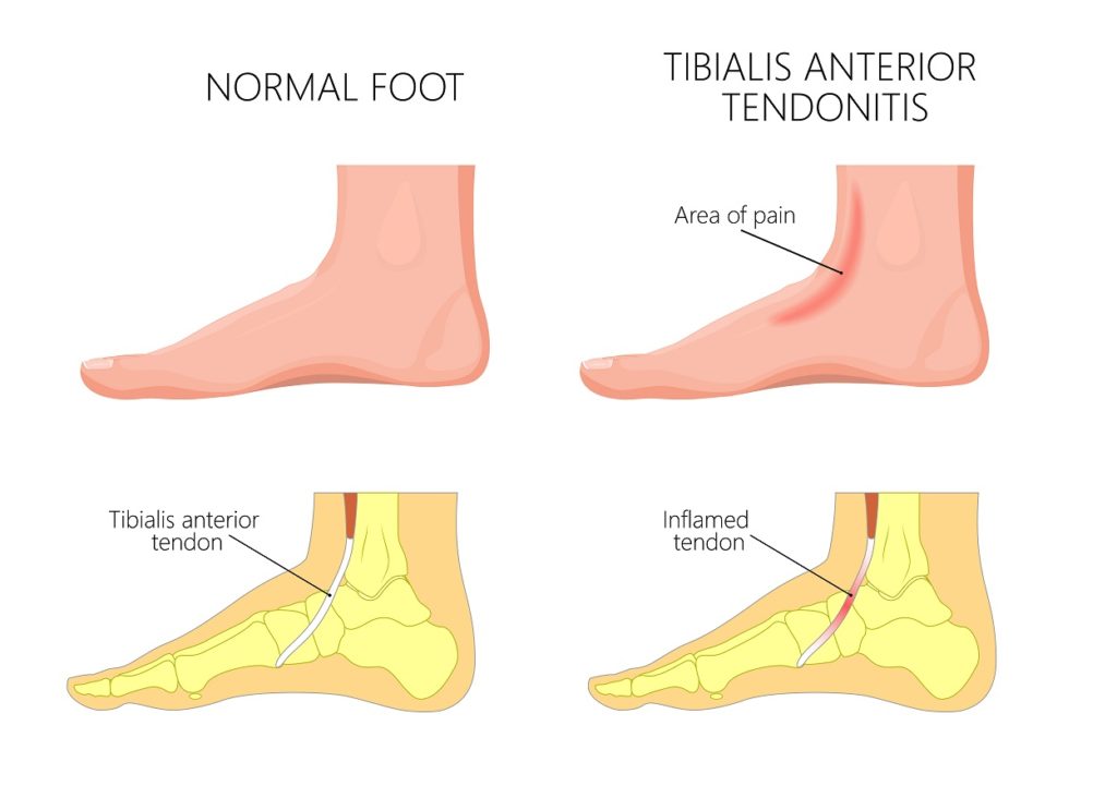 Pain in Middle of the Foot [Causes, Symptoms and Best Treatment]