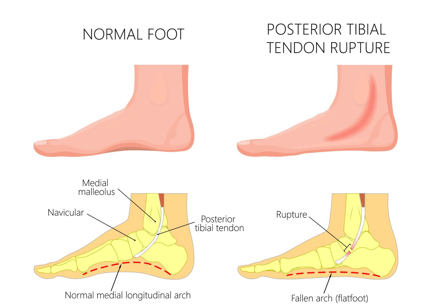 Sore Feet & Sore Ankles [Causes, Symptoms & Best Home Treatment]