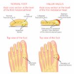 How to prevent bunions & bunion growth? [BEST way to prevent bunions!]