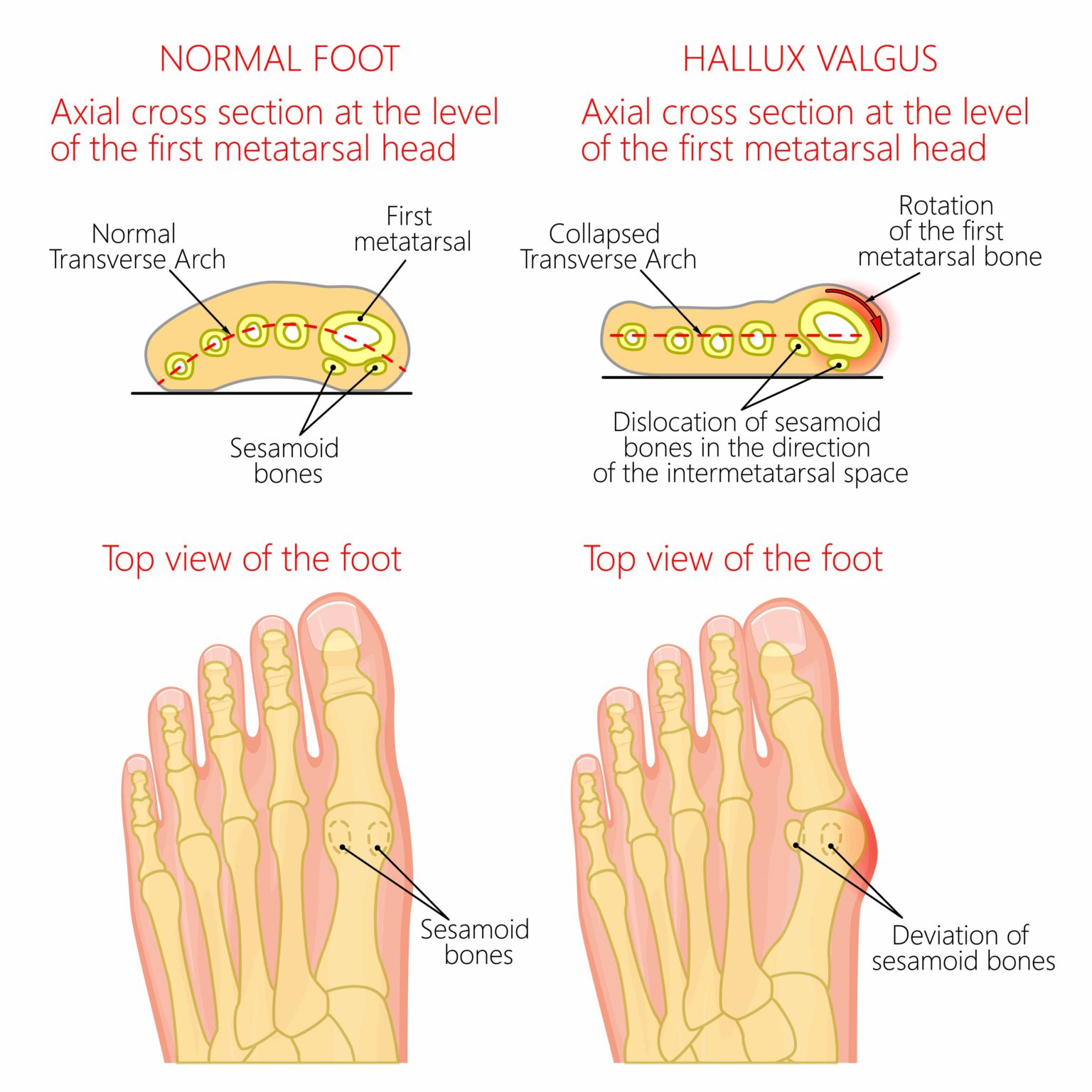 How To Prevent Bunions & Bunion Growth? [best Way To Prevent Bunions!]