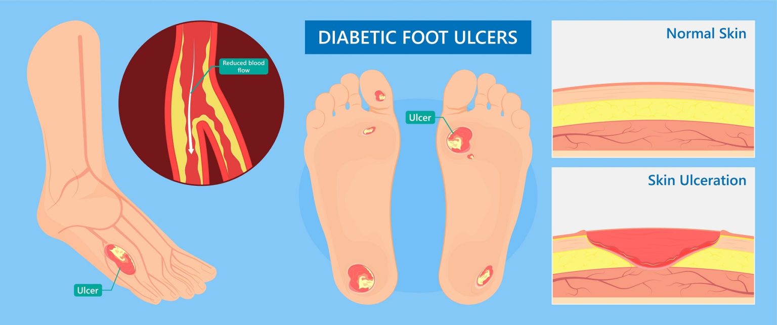 Diabetic Foot Doctor [Foot Specialists & Diabetic Podiatrist Near Me]