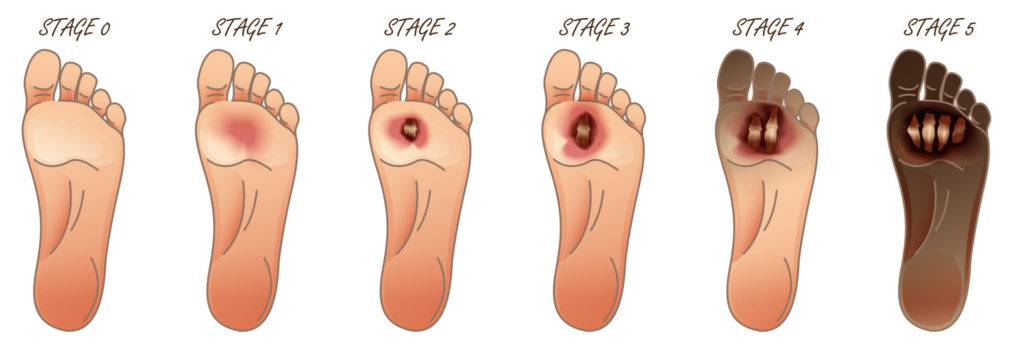 Staph Infection On The Toe Or Foot Early Signs BEST Treatment 