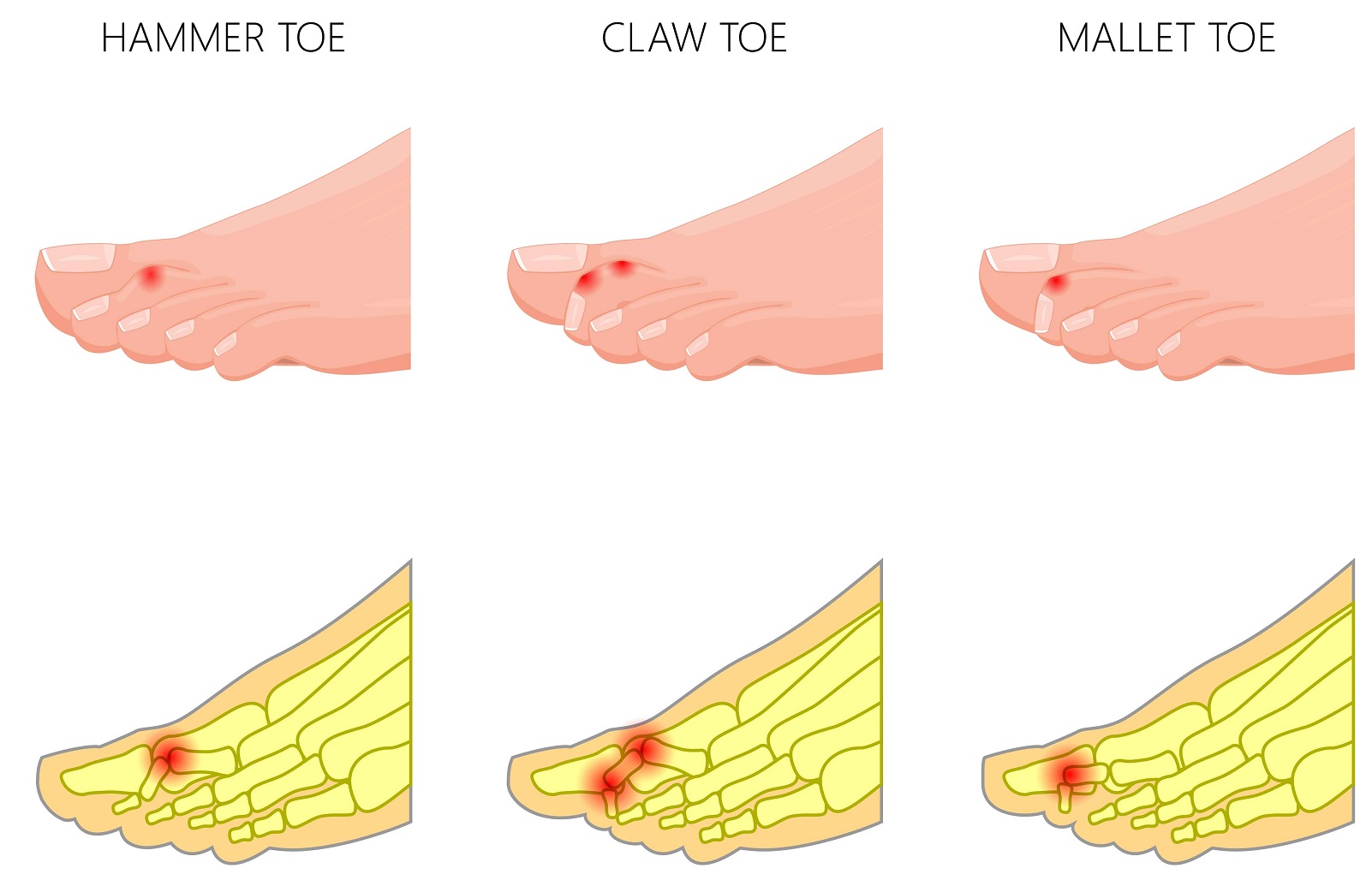 Why Are Your Toes Curling Down? - HealthyWomen