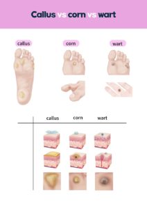 Plantar Wart Vs. Callus Vs. Corn [Plantar Wart Removal & Treatment]