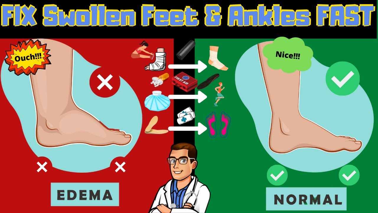 Edema [Fix Swollen Feet, Swollen Ankles & Swollen Legs FAST!]