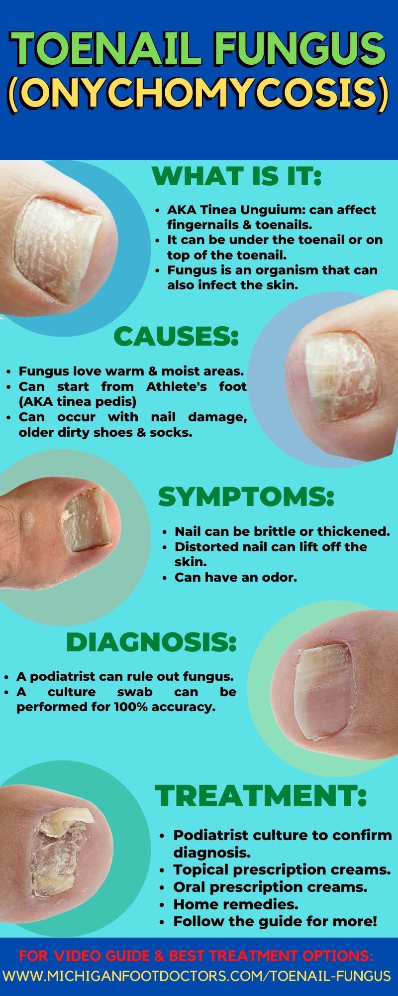 Types Of Toenail Fungus Symptoms At Terri Koehler Blog