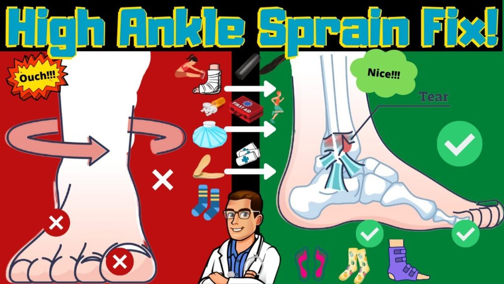 High Ankle Sprain And Syndesmotic Ankle Sprain [test And Recovery Time]