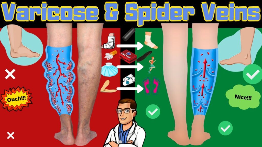 spider-veins-in-legs-varicose-veins-treatment-causes-symptoms