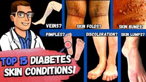 TOP 15 Diabetes Skin Signs & Symptoms [Type 2 & 1 Diabetes Mellitus]