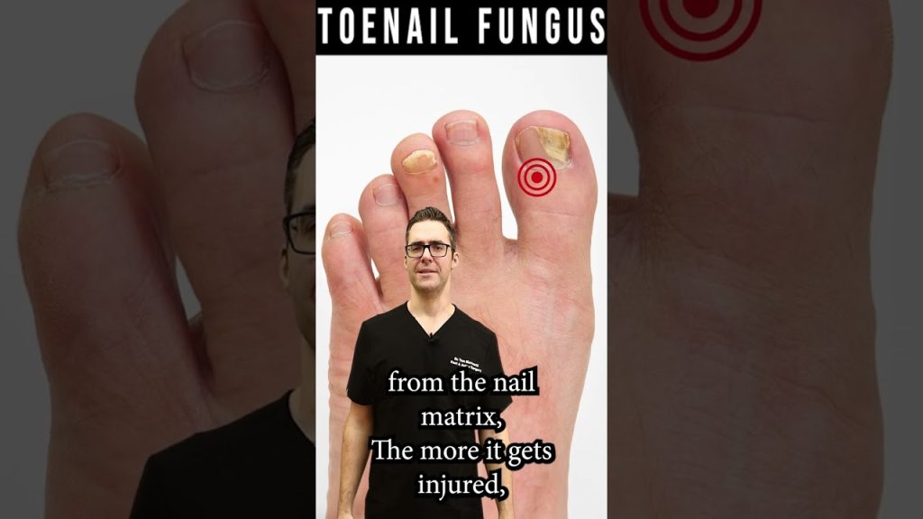 How To Know If Toenail Fungus Is Dying? [How Fast Do Nails Grow?]