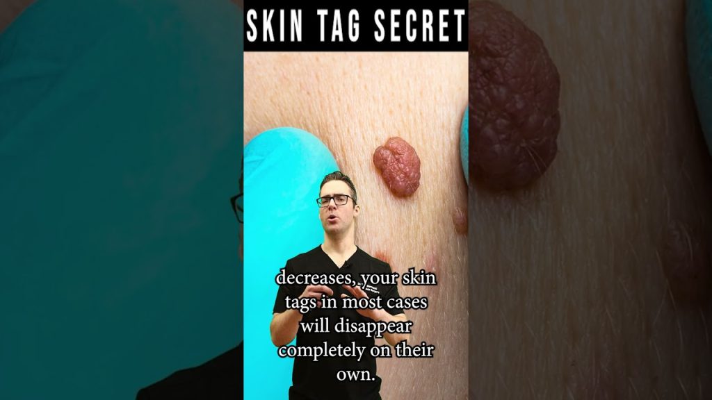 how-to-remove-skin-tags-forever-skin-tag-removal-secret