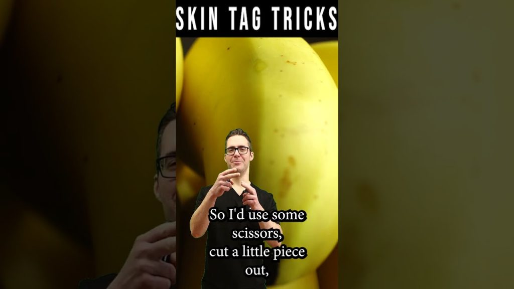 skin-tag-removal-wart-removal-natural-remedy-banana-peel-trick