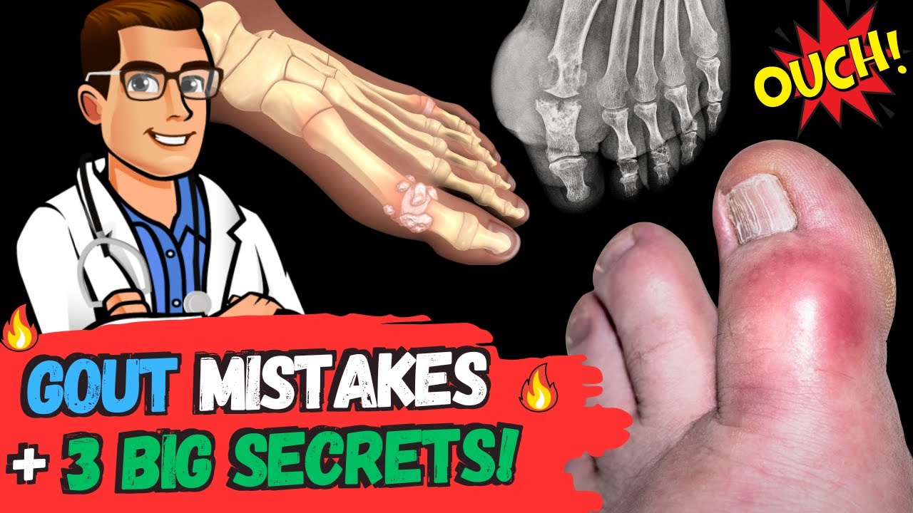 the gout mistakes 3 big secrets symptoms diet treatment