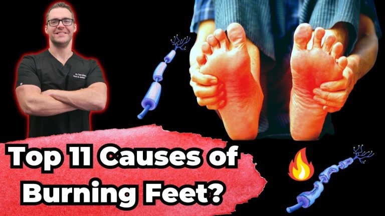 Top 11 Causes & Treatments of Burning Feet!